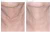 Revision Skincare Nectifirm Before and After Neck 8 Weeks