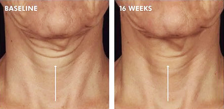 SKINCEUTICALS Tripeptide-R Neck Repair before and after