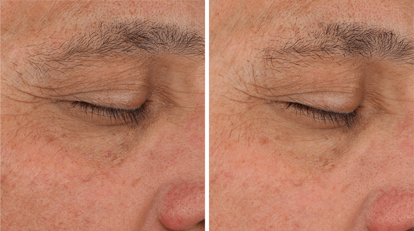 Sente- Illumine Eye Cream before and after