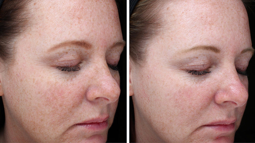 Sente- Intensive Bio Complete Cream before and after