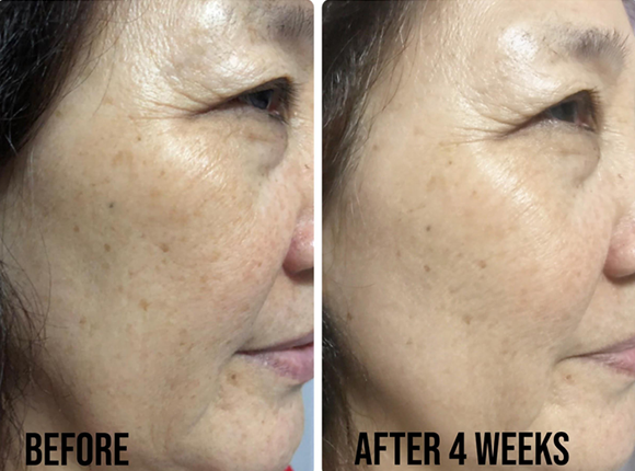 SkinCeuticals- Glycolic 10 Renew Overnight before and after
