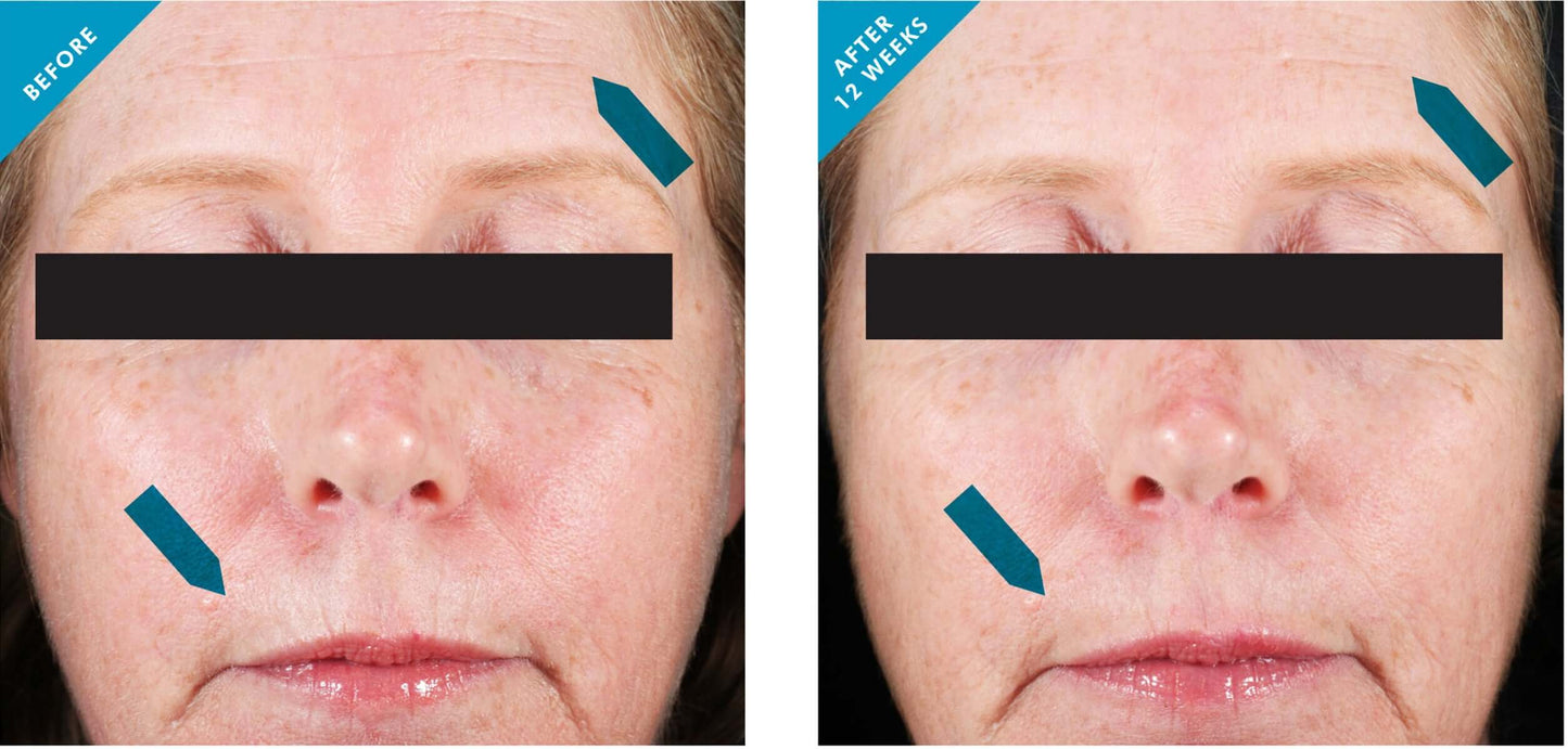 Before and after 12 weeks using SkinCeuticals Resveratrol B E night serum showing smoother, firmer, more radiant skin.
