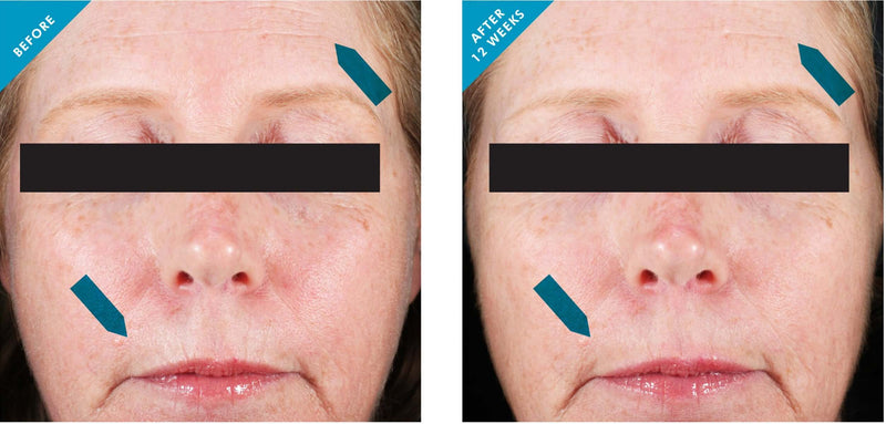 Before and after 12 weeks using SkinCeuticals Resveratrol B E night serum showing smoother, firmer, more radiant skin.
