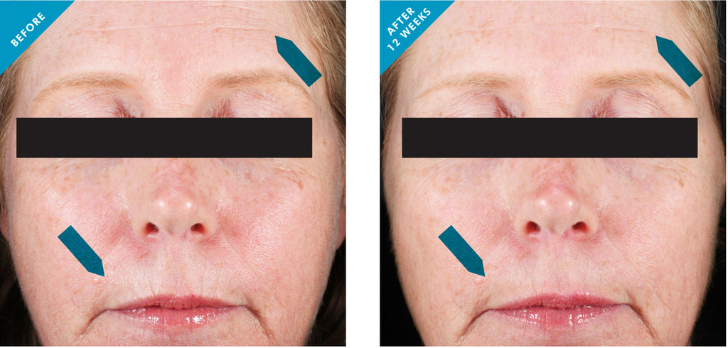 SkinCeuticals Resveratrol B E before and after results, showing improved skin appearance after 12 weeks