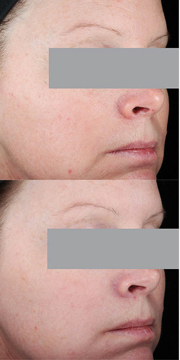 SkinCeuticals Resveratrol B E before and after, side view showing reduced fine lines and improved skin texture