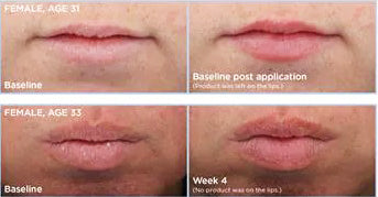 SkinMedica- HA5 Smooth & Plump Lip System before and after