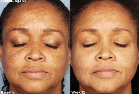 SkinMedica- LUMIVIVE System before and after