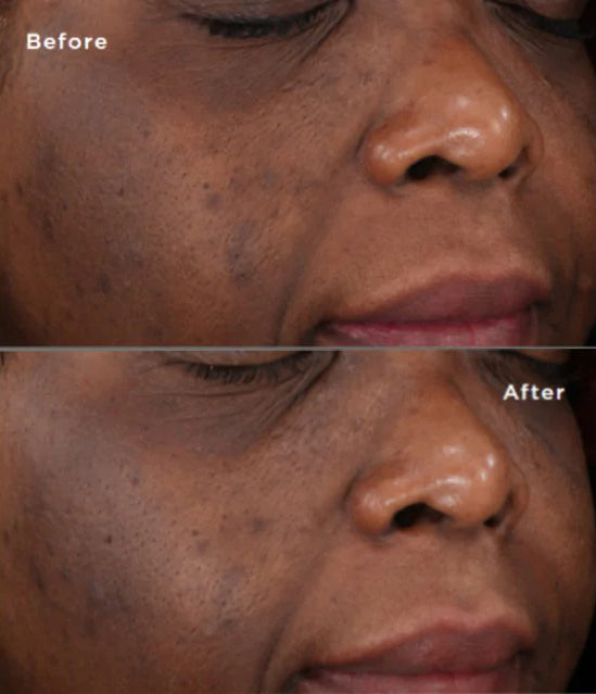 SkinMedica- Lytera 2.0 Pigment Correcting Serum Before and after
