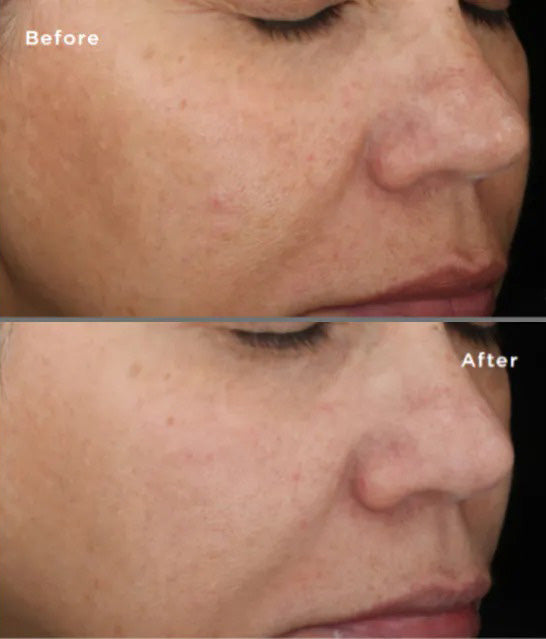 SkinMedica- Lytera 2.0 Pigment Correcting Serum before and after