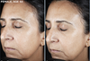 SkinMedica- Rejuvenative Moisturizer before and after