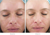 SkinMedica- Ultra Sheer Moisturizer before and after