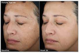 SkinMedica Dermal Repair Cream before and after