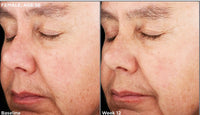 SkinMedica Retinol Complex 0.5 before and after