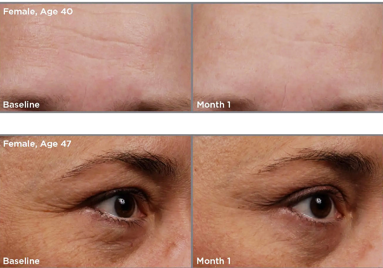 SkinMedica® TNS Essential Serum before and after