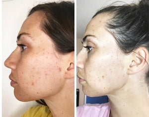 Super Serum Advance before and after