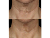 Revision Skincare Nectifirm Before and After Neck 12 Weeks
