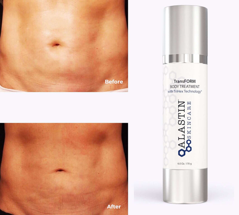 Alastin TransFORM Body Treatment before and after stomach results showing firmer smoother skin with improved texture