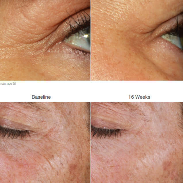 ALASTIN Restorative Eye Treatment before and after shows smoother fine lines and firmer-looking skin around the eyes results