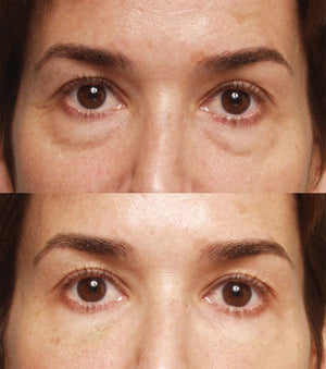 ALASTIN Restorative Eye Treatment before and after shows brighter-looking under eyes and improved eye area appearance result