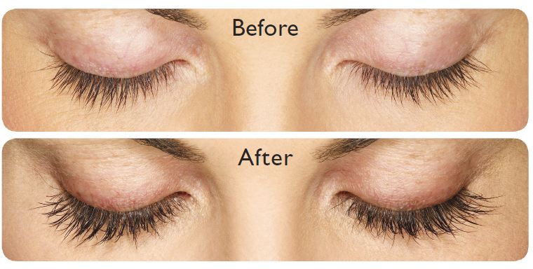 Before and after using Allergan Latisse, showing enhanced eyelash growth with increased thickness and length