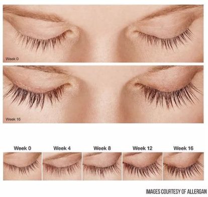 Progression of eyelash growth using Allergan Latisse from week 0 to week 16, showing significant increases in length and density