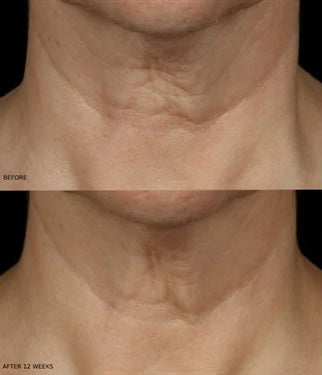 Before and after using Revision Skincare Nectifirm Advanced, 12-week results showing improved neck firmness and reduced wrinkles