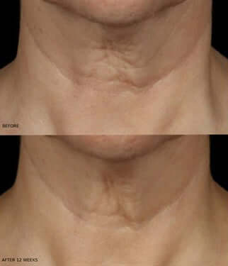 Before and after 12 weeks using Revision Skincare Nectifirm Advanced neck cream showing smoother neck appearance