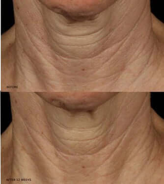 Before and after 12 weeks using Revision Skincare Nectifirm Advanced neck cream showing improved neck texture