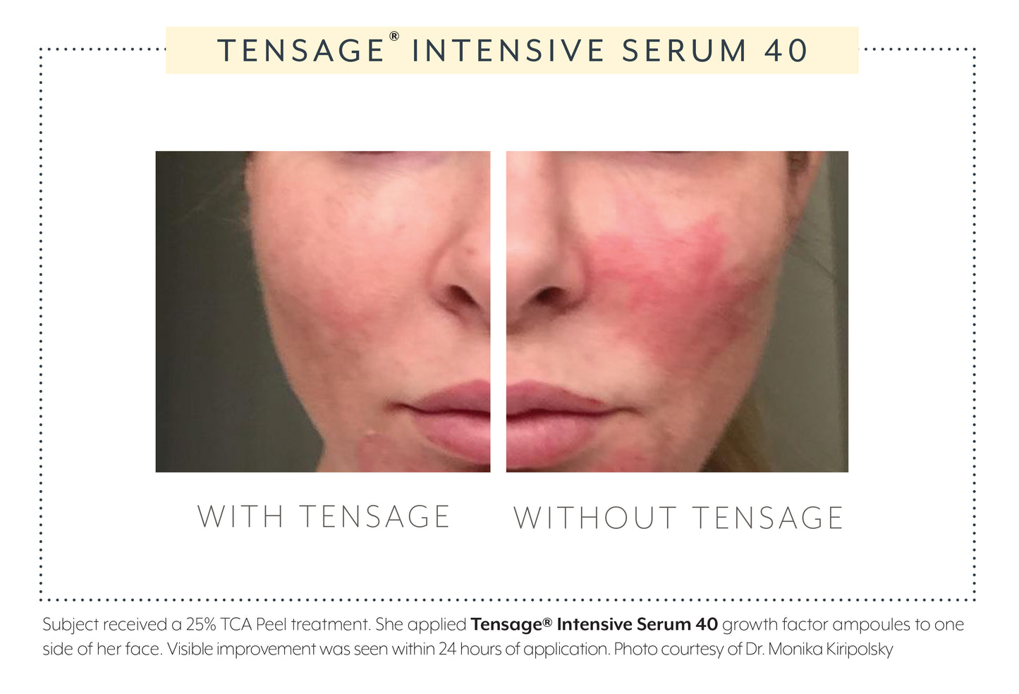 Split-face trial of Biopelle Tensage Serum 40 after a 25% TCA peel, showing less redness and faster recovery on treated side