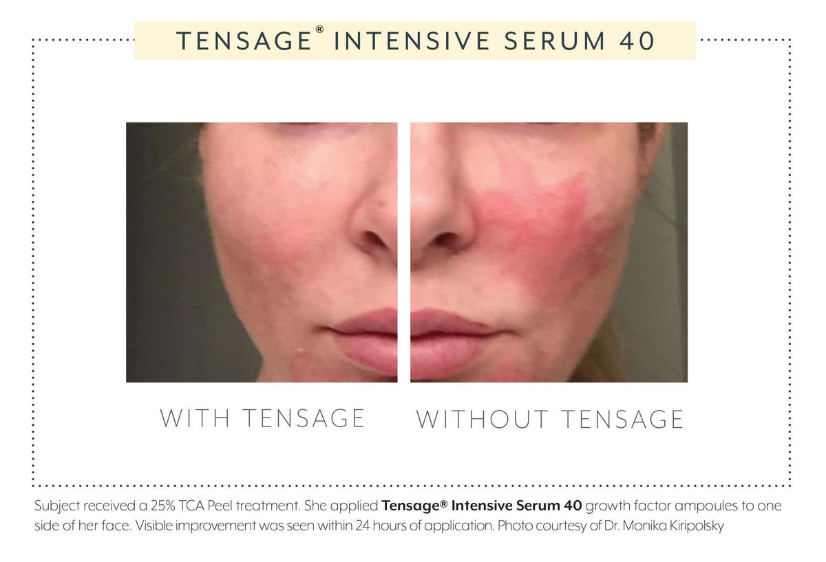Biopelle Tensage Intensive Serum 40 TCA peel results — split-face comparison showing accelerated post-procedure skin recovery