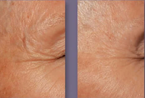 DefenAge 3D Eye Radiance Cream before and after eye wrinkle comparison shows smoother-looking crow's feet and eye area skin.