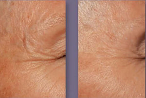 DefenAge 3D Eye Radiance Cream before and after eye wrinkle comparison shows smoother-looking crow's feet and eye area skin.