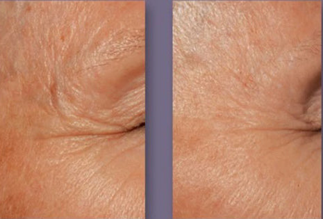 Before and after using DefenAge 3D Eye Radiance Cream, noticeable reduction in under-eye wrinkles