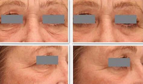 DefenAge 3D Eye Radiance Cream before and after grid shows eye area wrinkles, puffiness and smoother-looking under eye skin.