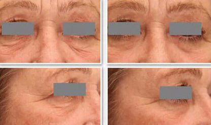 DefenAge 3D Eye Radiance Cream before and after grid shows eye area wrinkles, puffiness and smoother-looking under eye skin.