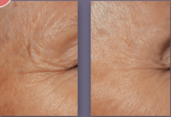DefenAge 8-in-1 BioSerum before and after eye wrinkle close-up shows smoother-looking crow's feet and eye area skin focus.
