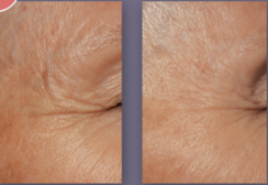 Before and after using DefenAge 3D Eye Radiance Cream, showing reduced eye wrinkles and smoother skin texture