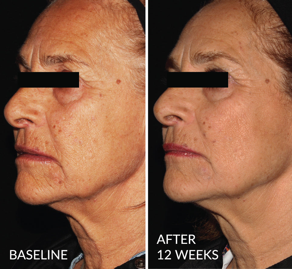 Before and after 12 weeks of using DefenAge 8-in-1 BioSerum, showing dramatic skin improvements and reduced signs of aging