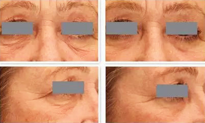 Comparative eye area results before and after using DefenAge Clinical Power Trio Fragrance Free, highlighting reduced wrinkles and smoother skin