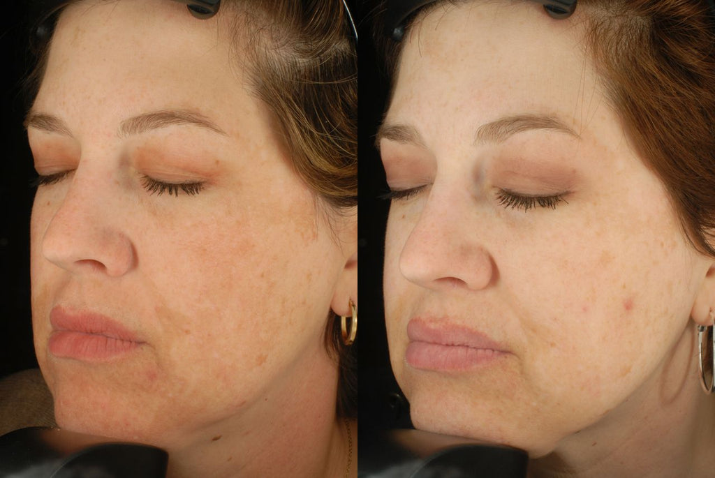 Before and after effects of Epionce Intense Defense Serum on cheek skin texture, showing reduced blemishes and smoother complexion