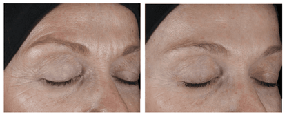 Before and after results of Epionce Intense Defense Serum showing improved eyelid skin texture and reduced signs of aging