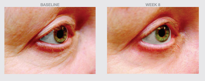 Comparison of eye area condition at baseline and after eight weeks of treatment, showing visible reduction in under-eye circles