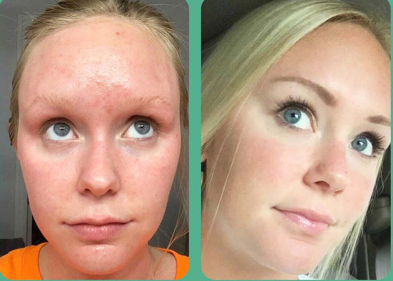 Before and after comparison showing reduced facial redness after using Revision Skincare Gentle Cleansing Lotion 6.7 oz