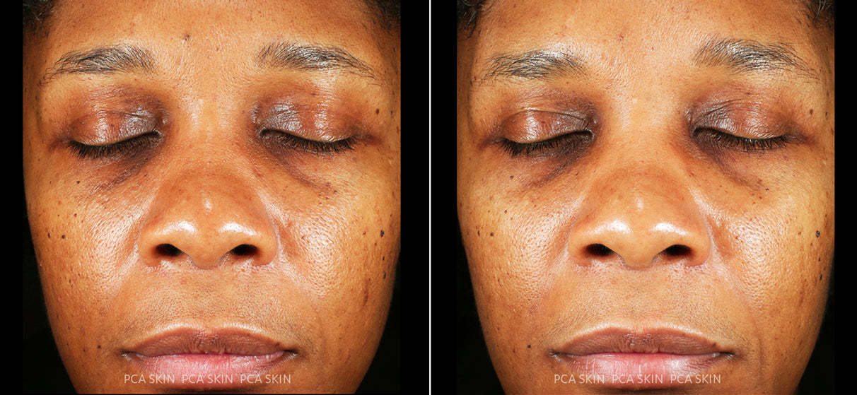 Hyaluronic Acid Boosting Serum before and after