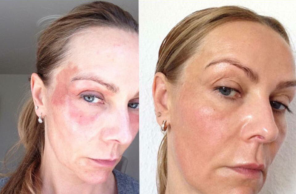 Before and after using iS Clinical Brightening Complex, showing significant reduction in facial redness and skin discoloration