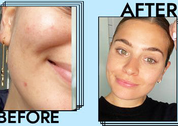 Before and after facial close-up using iS Clinical Cleansing Complex, demonstrating clearer skin and reduced blemishes