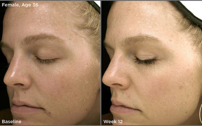 Before and after results of iS Clinical White Lightening Complex on a 36-year-old female over 12 weeks