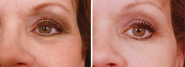 Before and after using iS Clinical Youth Eye Complex, showing noticeable reduction in under-eye wrinkles and firmer skin