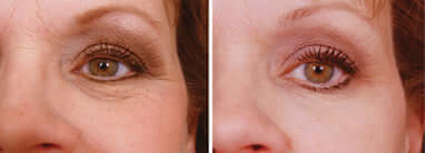 iS Clinical Youth Eye Complex before after eye photo shows visible under eye line comparison for aging skin care review use.