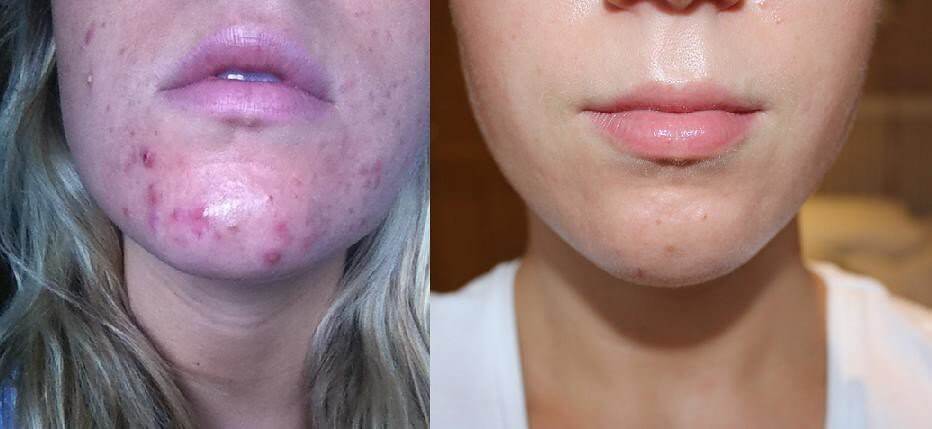 Before and after acne results showing improved chin breakouts after using LightStim for Acne LED light therapy device daily.